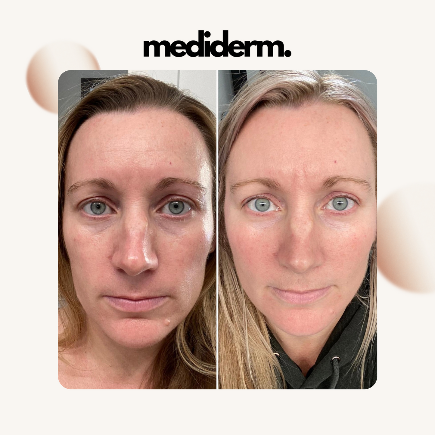 Try Lyftr Face Device