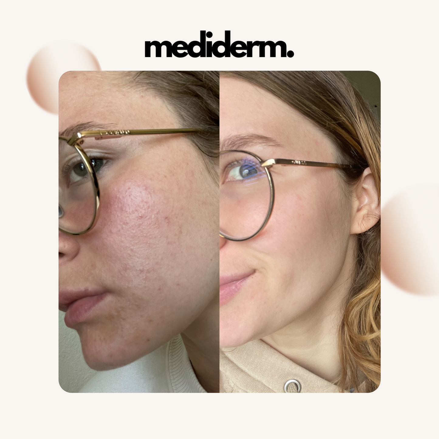 Try Lyftr Face Device